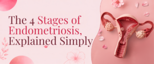 The 4 Stages of Endometriosis, Explained Simply