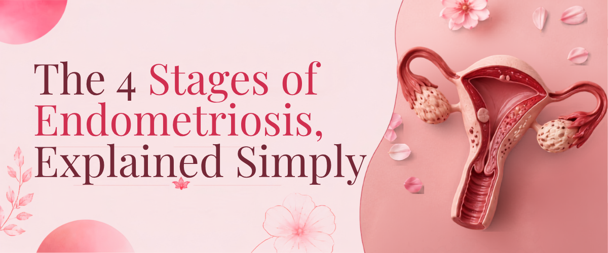 The 4 Stages of Endometriosis, Explained Simply